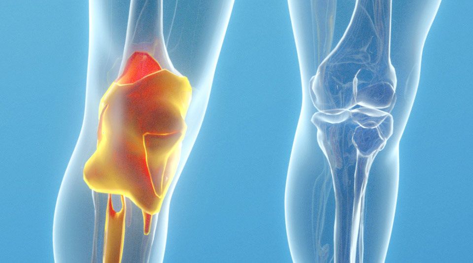 Diz protezi ameliyatı