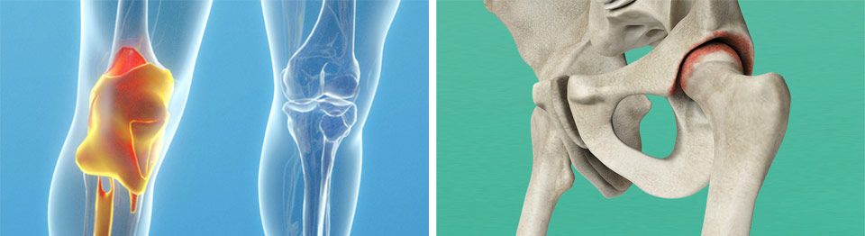 Diz protezi ameliyatı