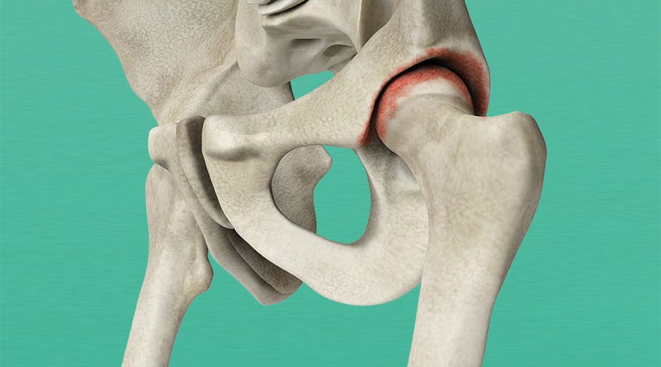 Kalça protezi ameliyatı